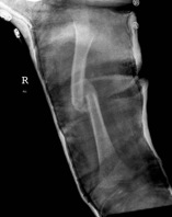 Paediatric Femur Fracture 1 month